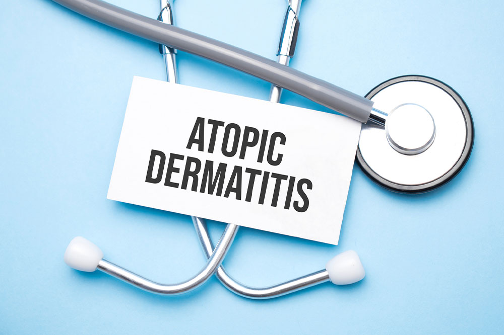 Atopic dermatitis – Symptoms and management tips